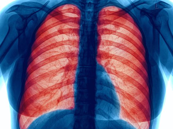 Asbestosis: Causes, Symptoms, Diagnosis & Treatment